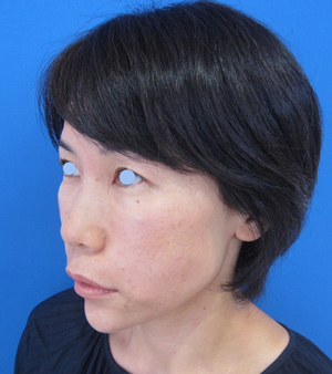目の下のたるみ、目のくまでお悩みの方、切らずに完璧に解決します。TCB-R法　手術直後　症例写真